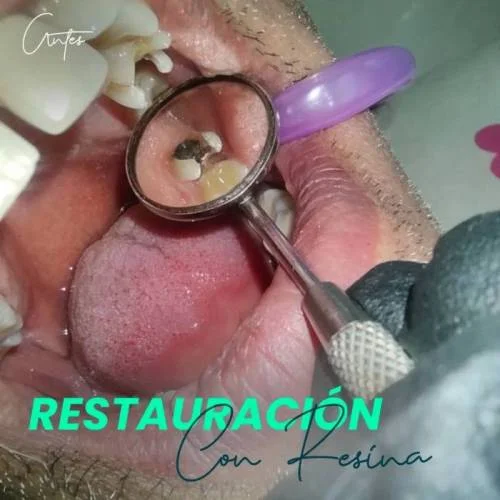 Restauración con Resina