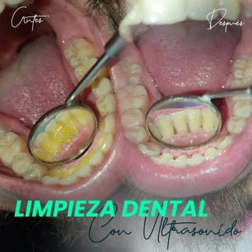 Limpieza Dental Con Ultrasonido