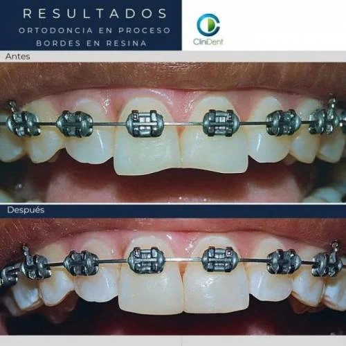 Ortodoncia en proceso bordes en resina