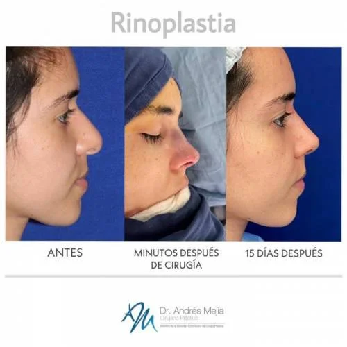 Rinoplastia