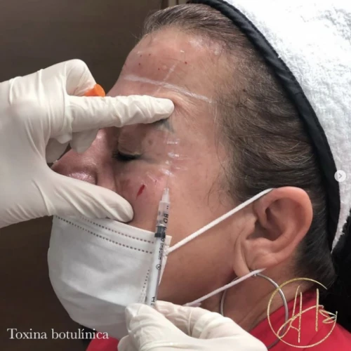 Aplicación de Toxina botulínica