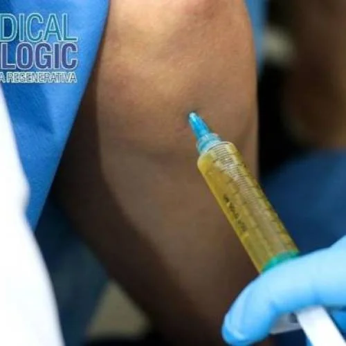 Plasma rico en plaquetas para osteoartritis de rodilla. 