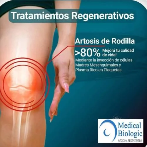 Plasma rico en plaquetas para osteoartritis de rodilla. 