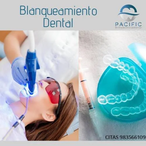 Blanqueamiento Dental